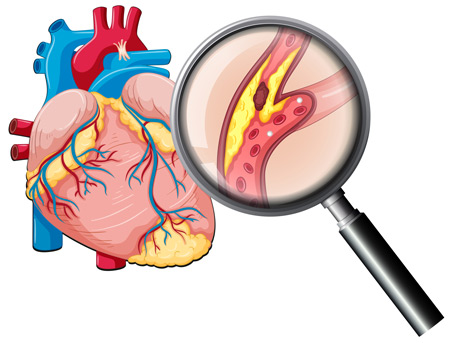 Damarlarda kireçlenme ve Tam tıkalı kalp damarları (CTO)